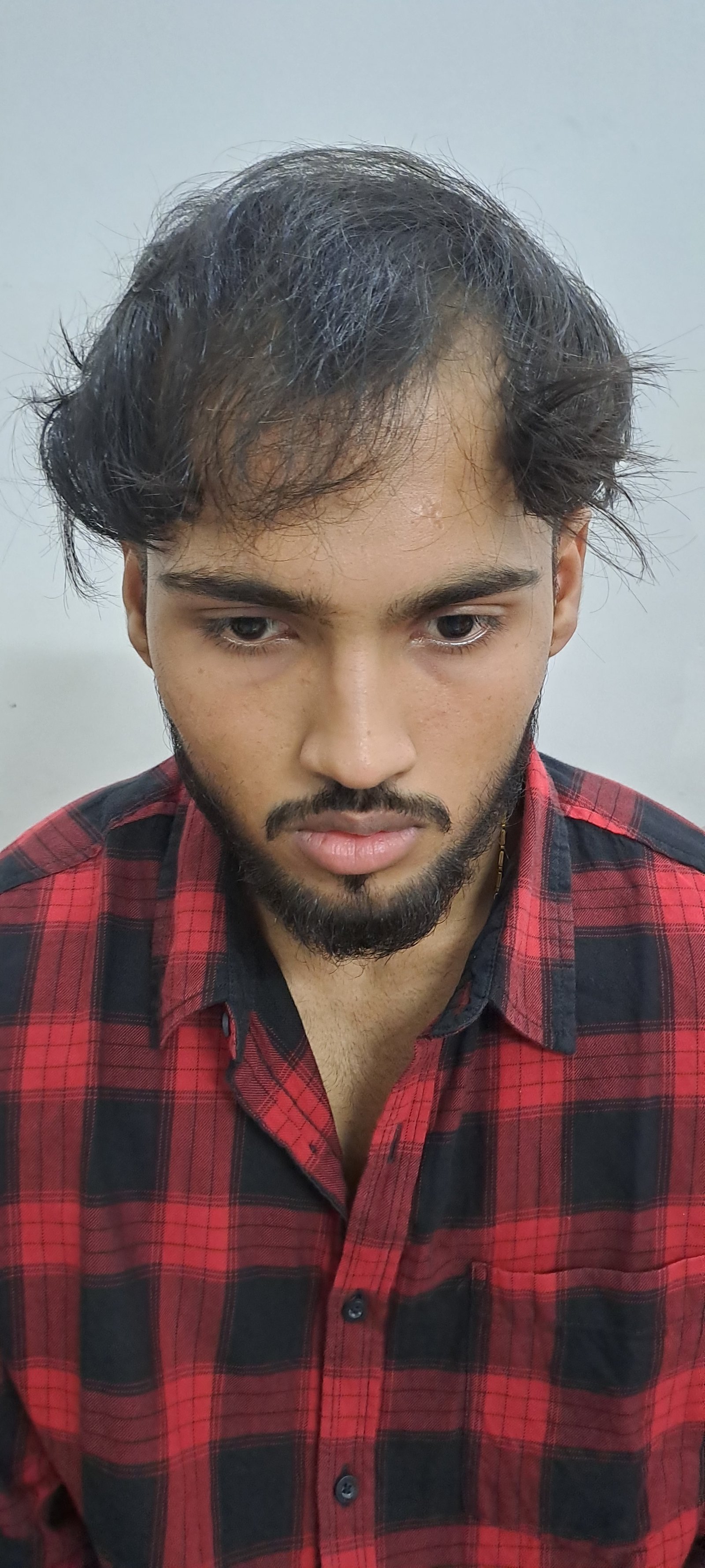 Patient Before Hair Transplant